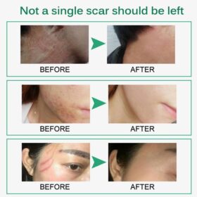 Intensive Scar Removal Cream - image 5