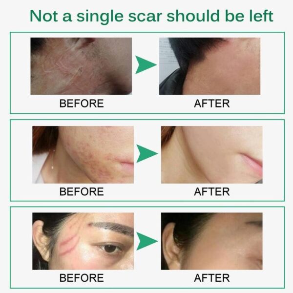 Skin Rebound Scarless Cream Scar Removal Cream Face Cream For Face Acne Scar Stretch Marks Skin 9