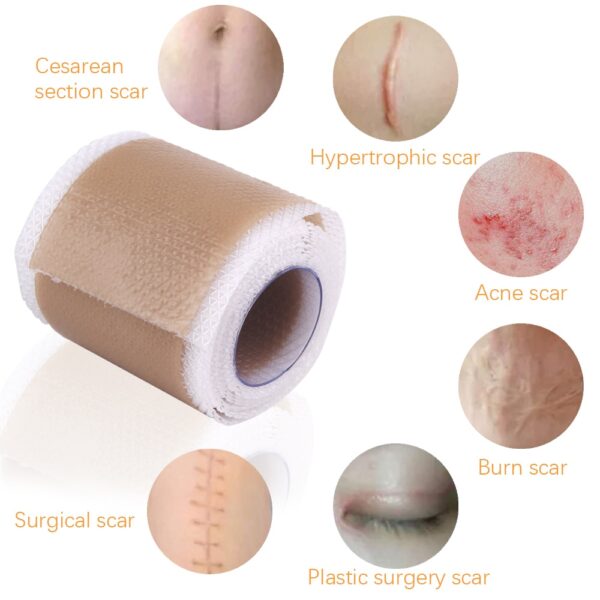 4x50cm Surgery Scar Removal Silicone Gel Patch Treatment Tape Efficient Acne Trauma Burn Scar Therapy Sheet 2
