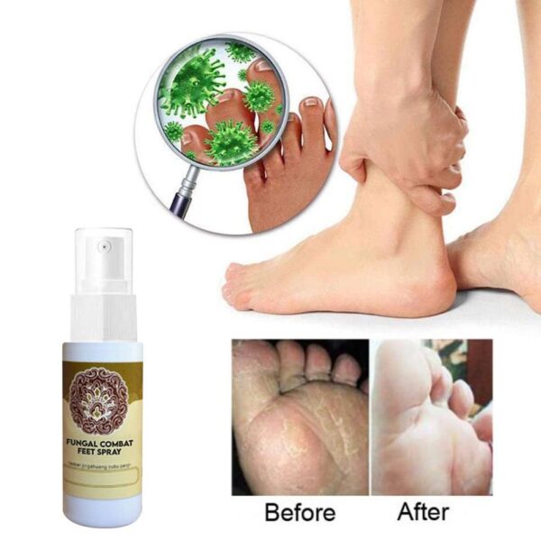 Fungal Combat Feet Spray Foot Sterilize Spray Herbal Anti fungal Infection Toe Treatment Onychomycosis Anti Bacterial 1
