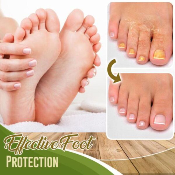 Fungal Combat Feet Spray Foot Sterilize Spray Herbal Anti fungal Infection Toe Treatment Onychomycosis Anti Bacterial 4