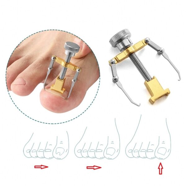 Straightening Clip Ingrown Toenail Corrector Pedicure Foot Nail Care Tools Stainless Steel Pedicure Treatment Nail Correction 2