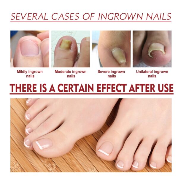 Anti Paronychia Relief Oil Cure Pain Reduce Ingrown Toenails Drops Corrector Repair Liquid Anti fungal Disinfects 2