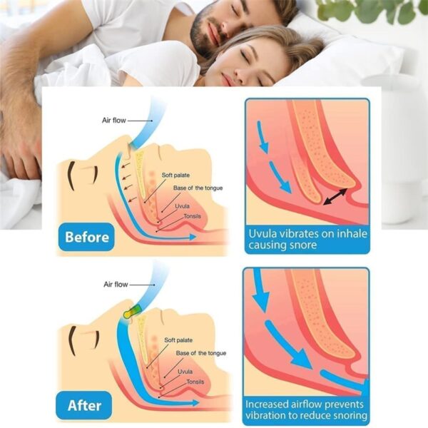 Anti Snoring Corrector Snore Prevention Gadget Women s Anti Snore Device Snore Elimination Nose Clip Men 1